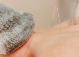 foto-servicios-acupuntura